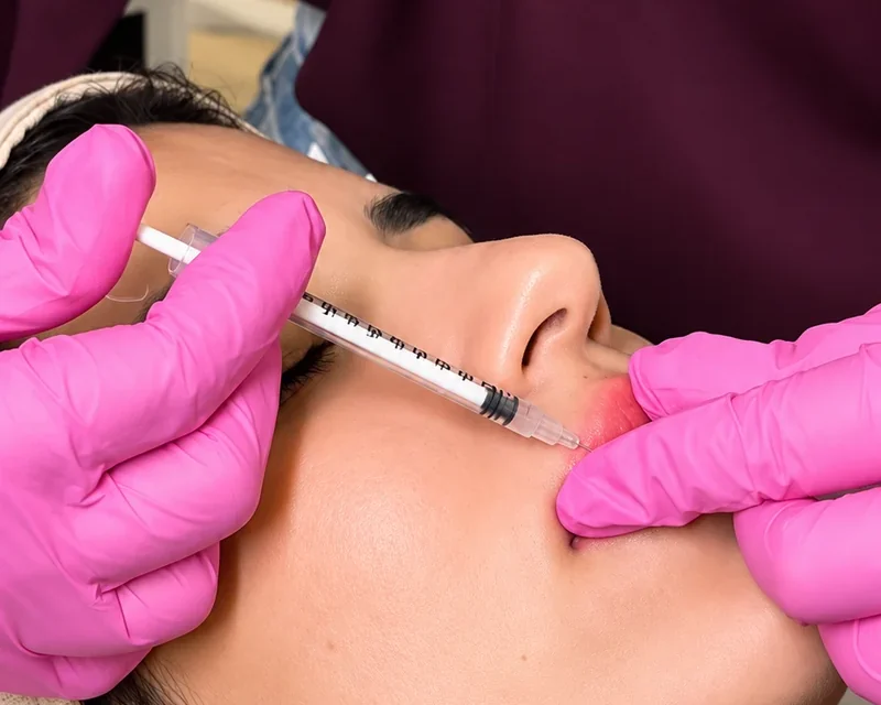 Aplicação com seringa na região dos lábios, feita com luvas